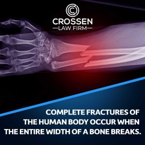 complete fracture
