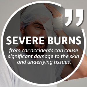 severe burns from car accident