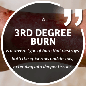 crossen burn injuries 3rd degree